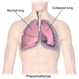 Collapsed lung