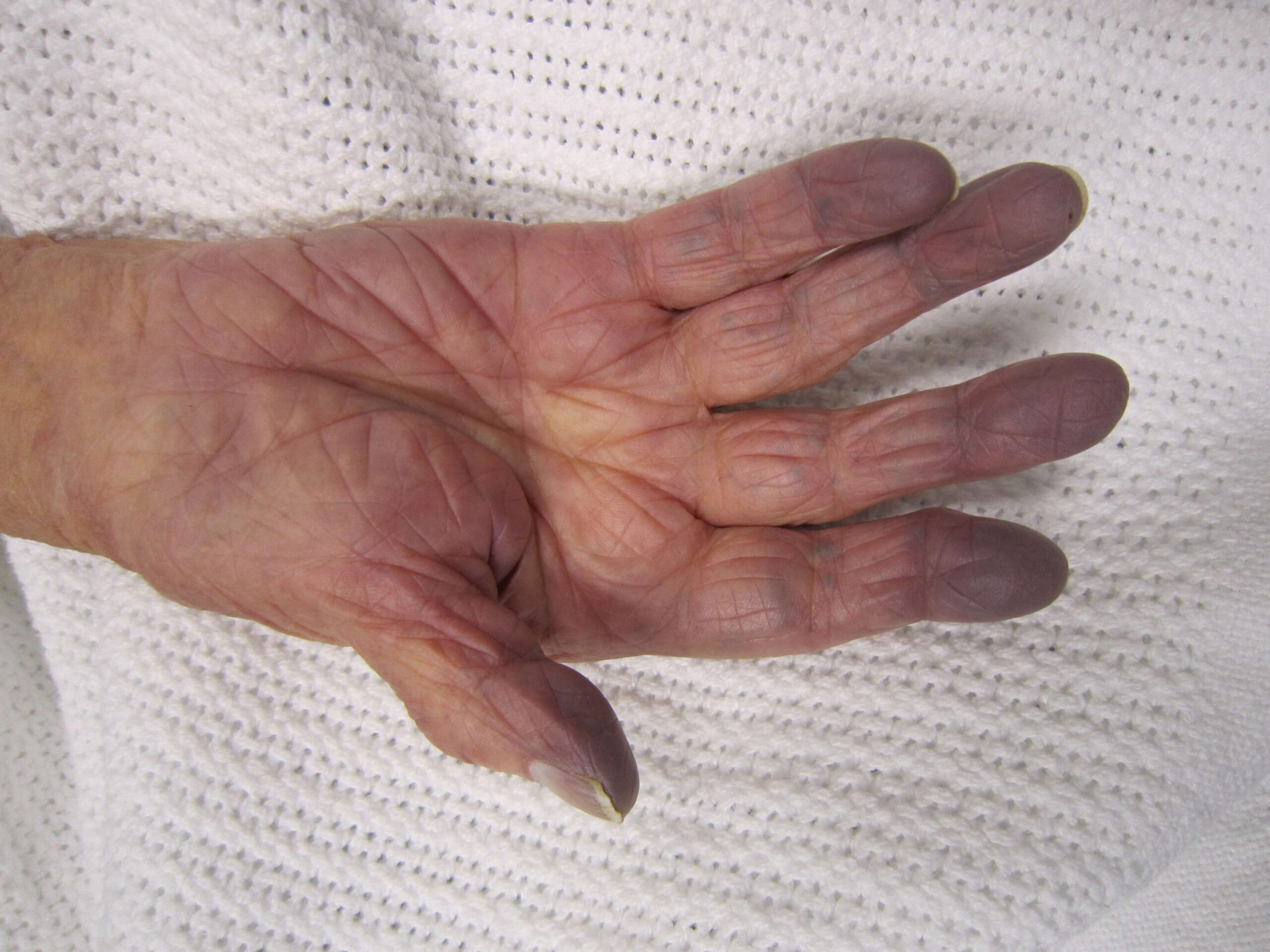 Cyanosis due to low oxygen levels